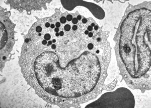 M,32y. | blood - eosinophilic leukemia